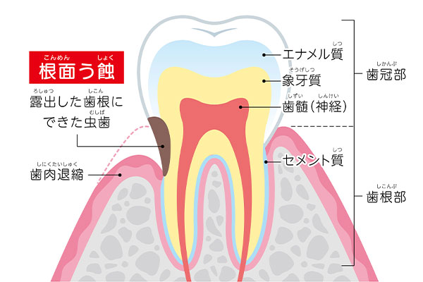 歯肉退縮を放置するリスク